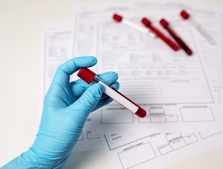 Povišena ili snižena ureja u krvi: Što nam govore laboratorijski nalazi?