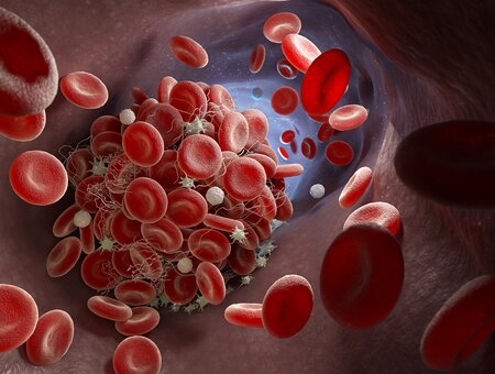 Krvni ugrušak: Kako prepoznati simptome tromba?