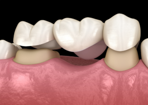 3d vizualizacija zubnog mosta