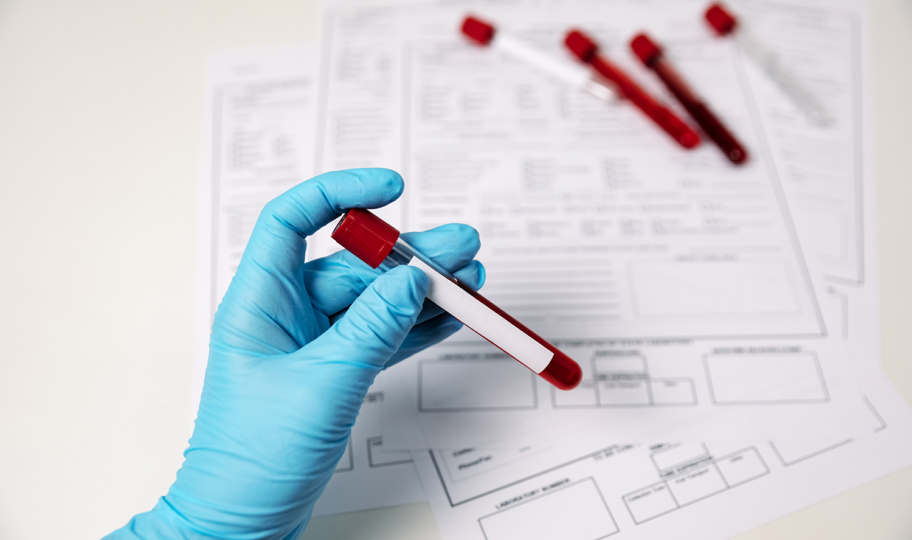 Ruka u medicinskim rukavicama drži ampulu krvi