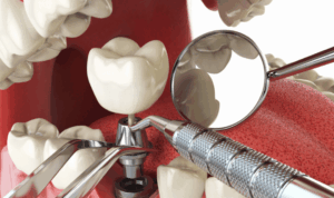 3d vizualizacija ugradnje implantata u donju čeljust