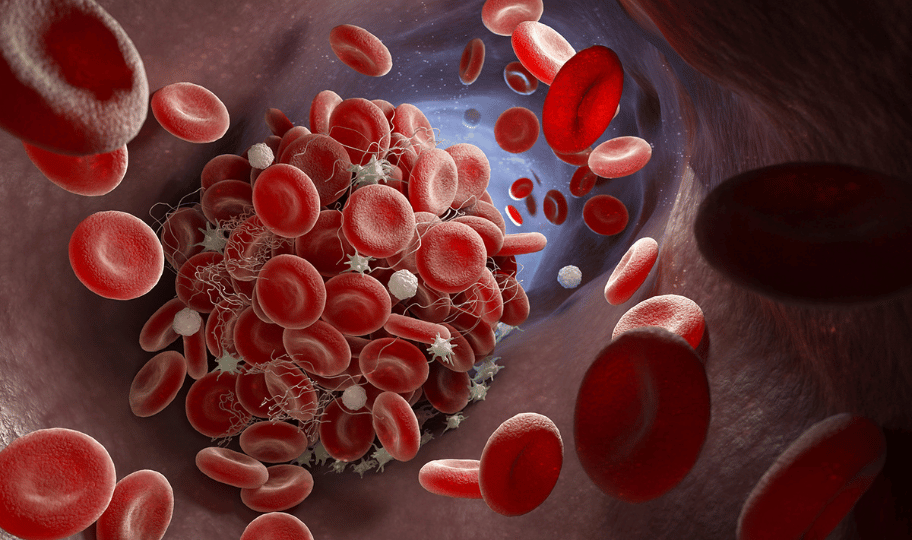 3D vizualizacija krvnog ugruška unutar vene