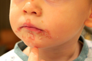 krupni kadar lica djeteta prekrivenog slatkim krastama ili impetigom