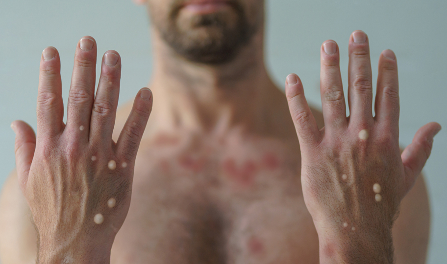 krupni kadar muških ruku s osipom uzrokovan majmunskim boginjama