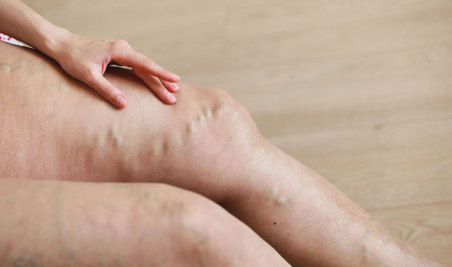 hkrupni kadar nogu s proširenim venama