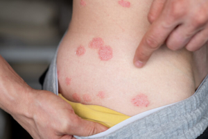 osoba pokazuje psorijazu na svom boku