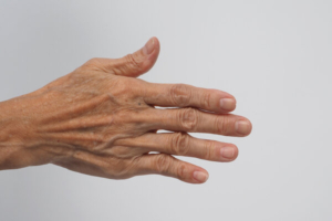 šaka osobe s reumatoidnim artritisom