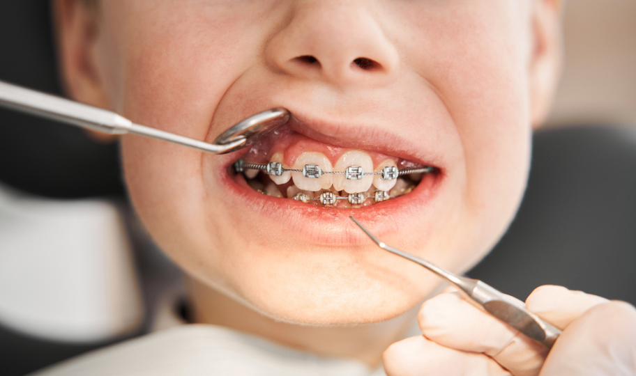 krupni kadar ustiju dječaka s fiksnim aparatićem