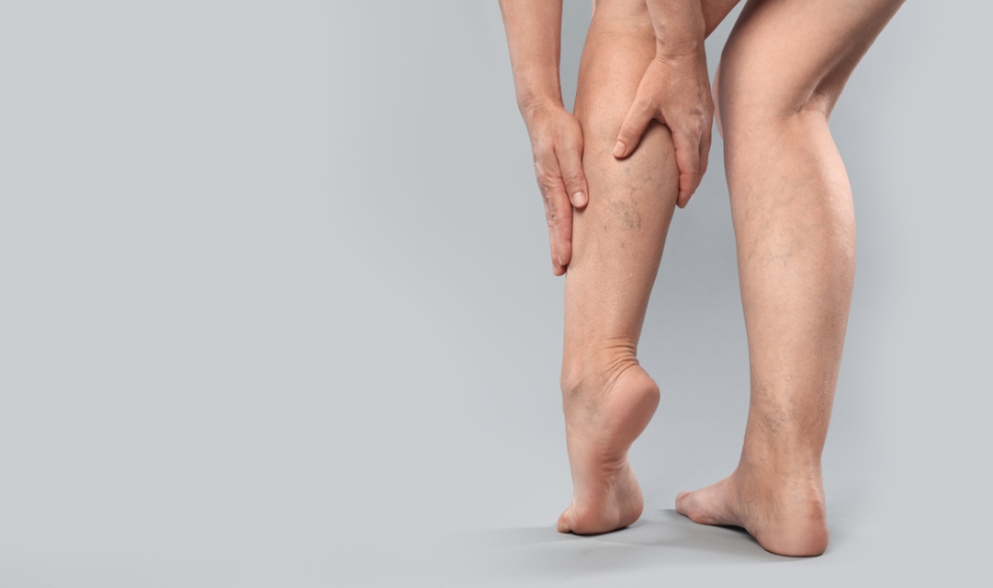 krupni kadar nogu s varikoznim venama