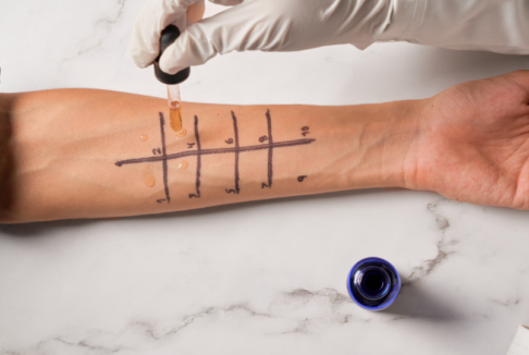 prick test na alergije