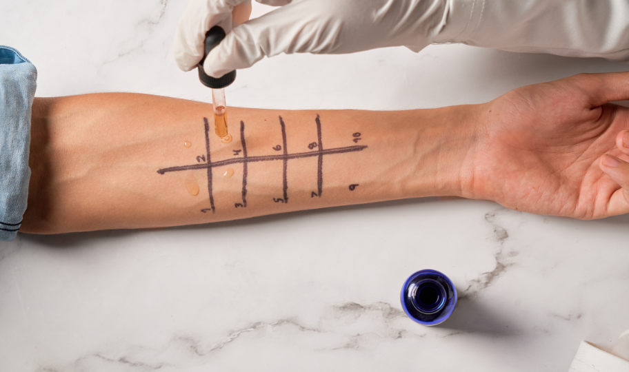 prick test na alergije