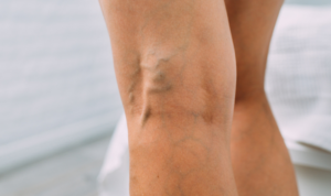 krupni kadar proširenih vena