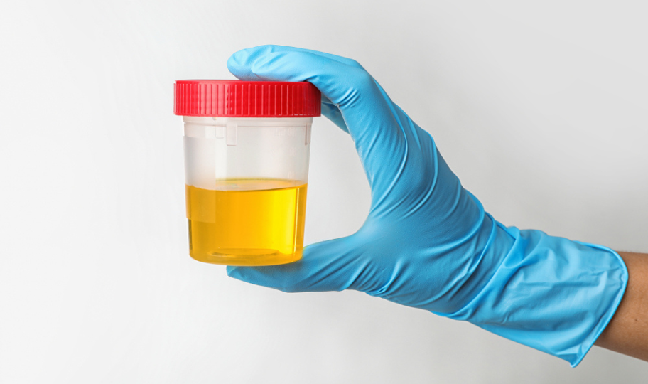 ruka u medicinskoj rukavici drži uzorak urina