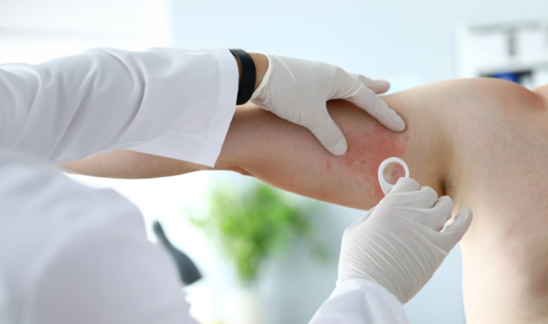 dermatolog pregledava pacijenta s urtikarijom