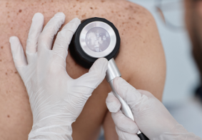 krupni kadar pregelda madeža dermatoskopom