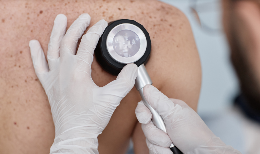 krupni kadar pregelda madeža dermatoskopom